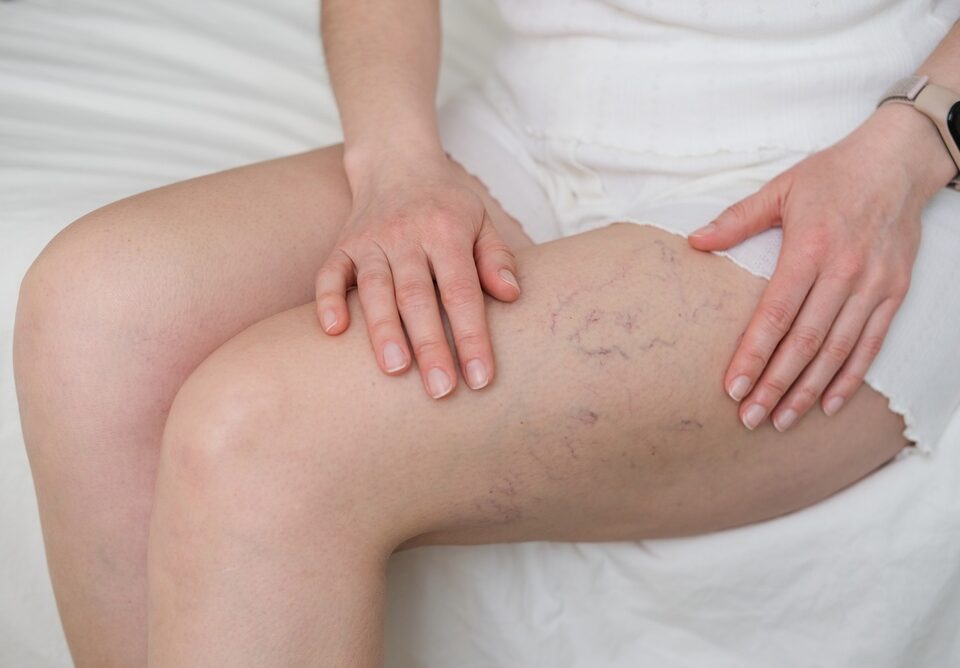 veins suddenly showing up on woman's legs
