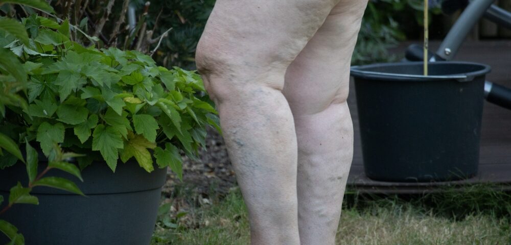 overweight woman with varicose veins in Westminster MD