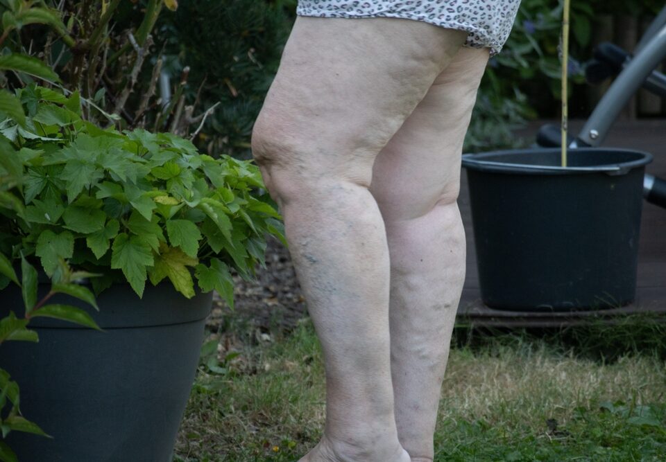 overweight woman with varicose veins in Westminster MD